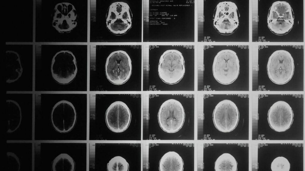 AI 将脑部 MRI 转化为潜在的中风预测因子