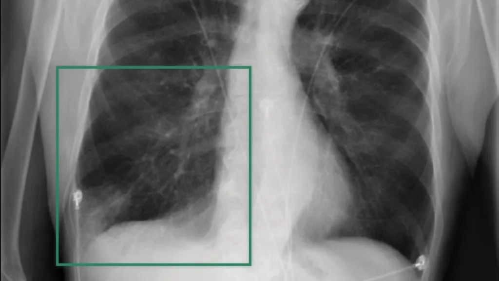 借助 NVIDIA Clara Reason 推进放射学研究中的可解释 AI