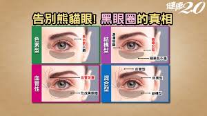 黑眼圈是睡眠不足导致的吗