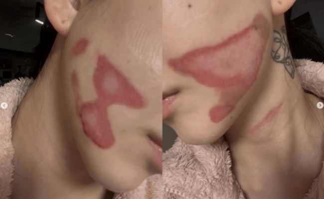 权珉娥做医美导致面度灼伤 正在准备提起诉讼