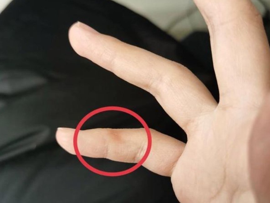 小拇指凹坑，就是新时代的“手机病”