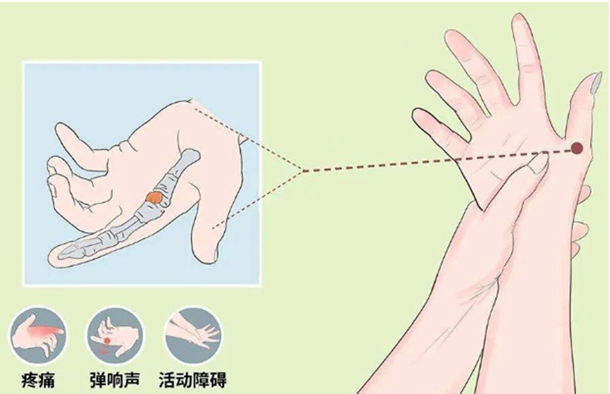 小拇指凹坑，就是新时代的“手机病”